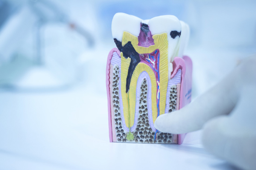 عوامل ایجاد پوسیدگی دندان
