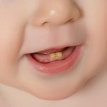 تغییر رنگ دندان در نوزادان و کودکان نوپا – علل و درمان آن