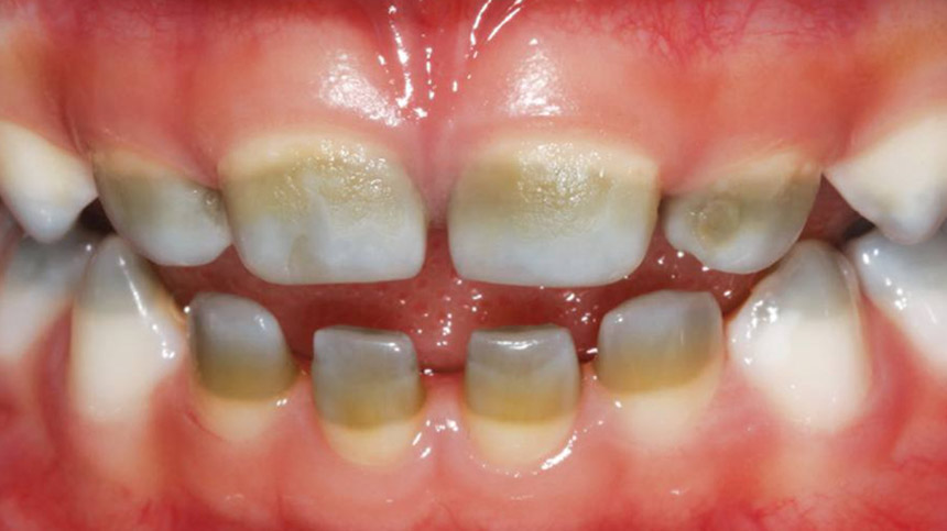 رنگ سبز در مینای دندان به دلیل بیماری هایپربیلیروبینمی