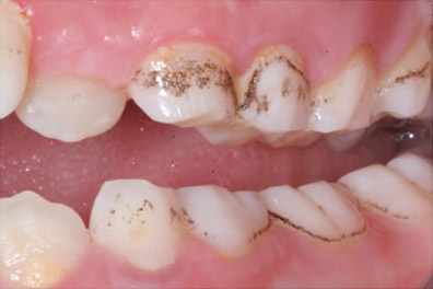 لکه‌های سیاه روی دندان به دلیل استفاده از مکمل‌های آهن